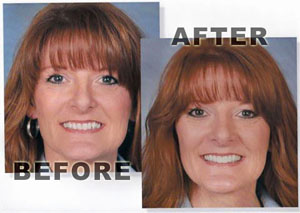 beforeafter